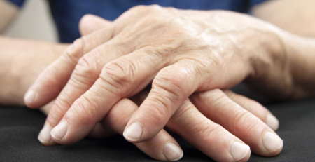 Tratamento da artrite reumatoide com baricitinib está associado a um alívio significativo da dor do que MTX, conclui estudo